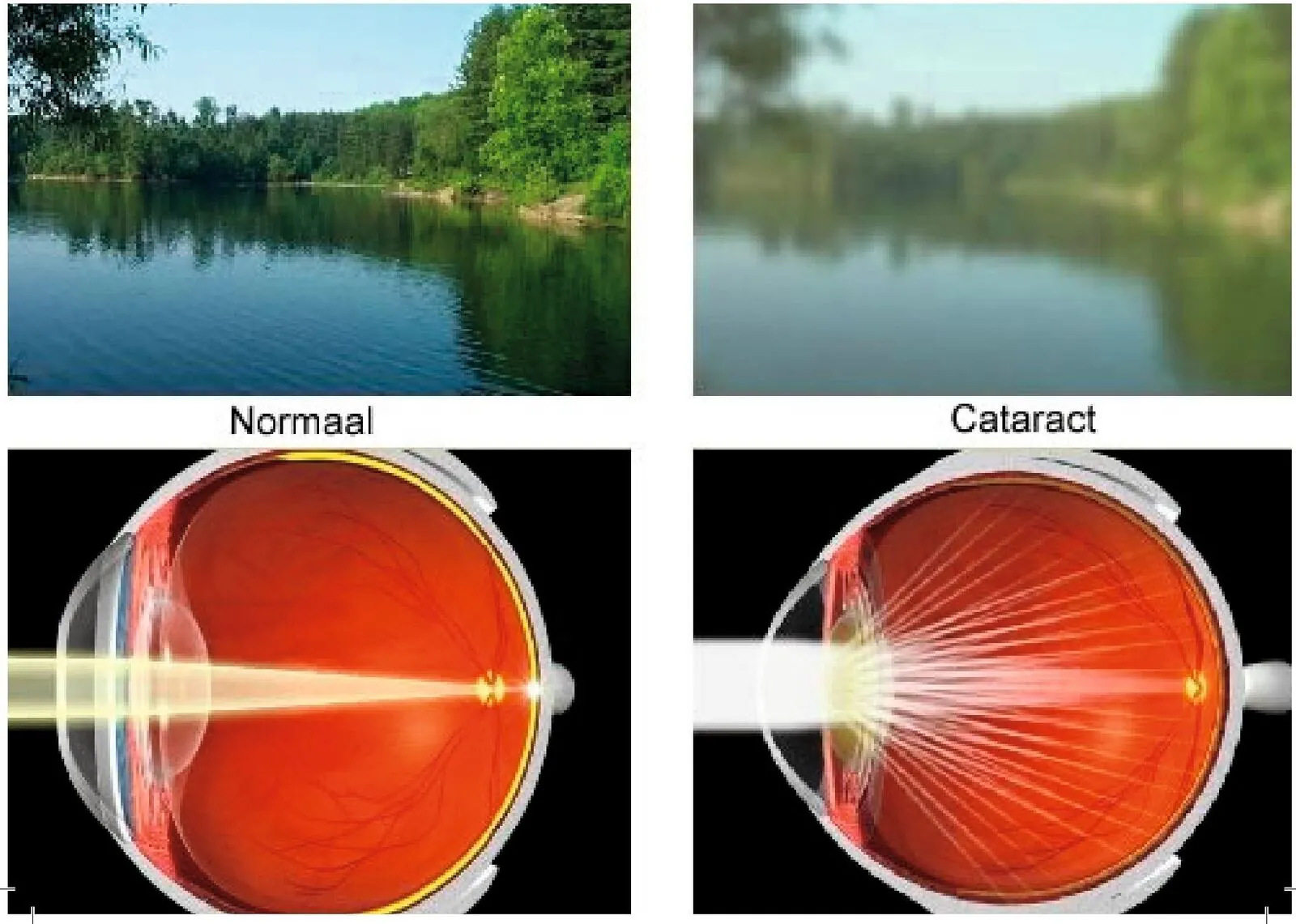 Comparison of normal vision versus cataract