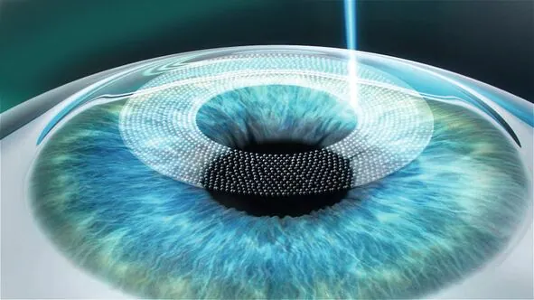 Femtosecond laser creates a precise corneal flap