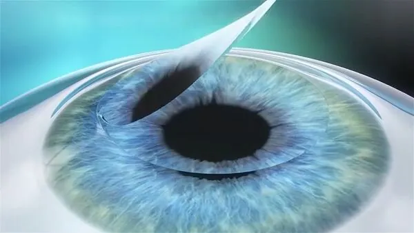 Surgeon gently lifts the flap