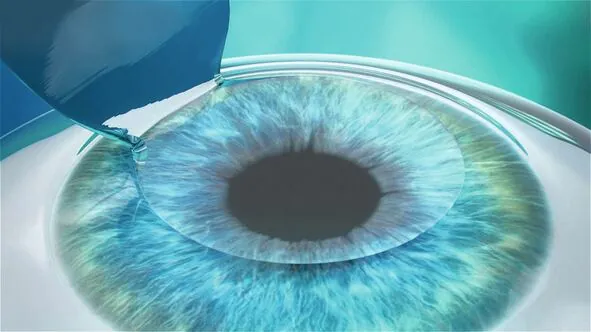 The lifted flap exposes the corneal stroma