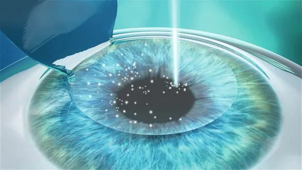 Excimer laser corrects the prescription on the cornea