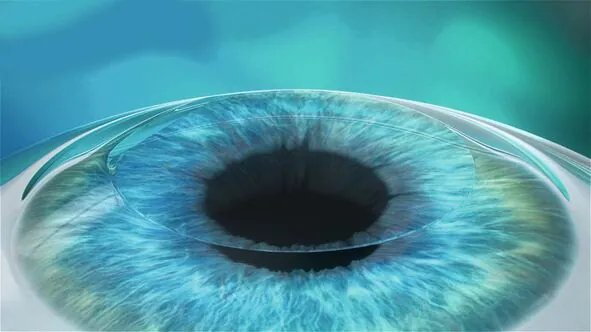 Flap is placed back on the cornea