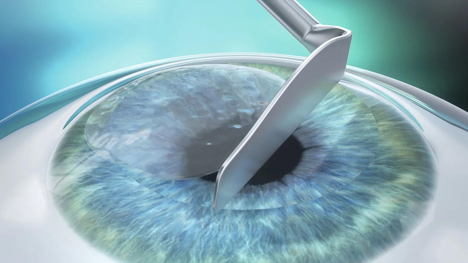The epithelium is removed mechanically with a small brush