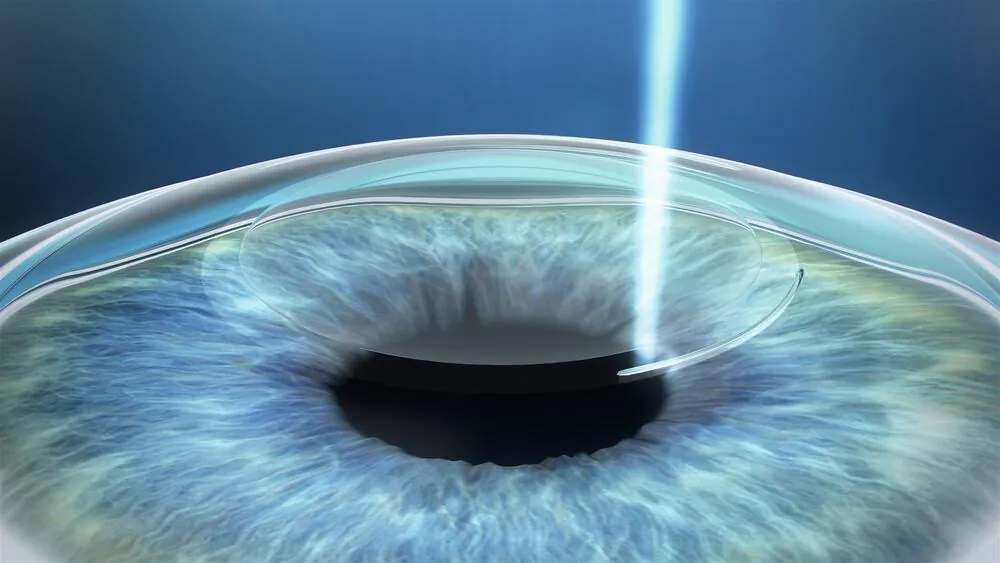Femtosecond laser cuts a lenticule in the cornea