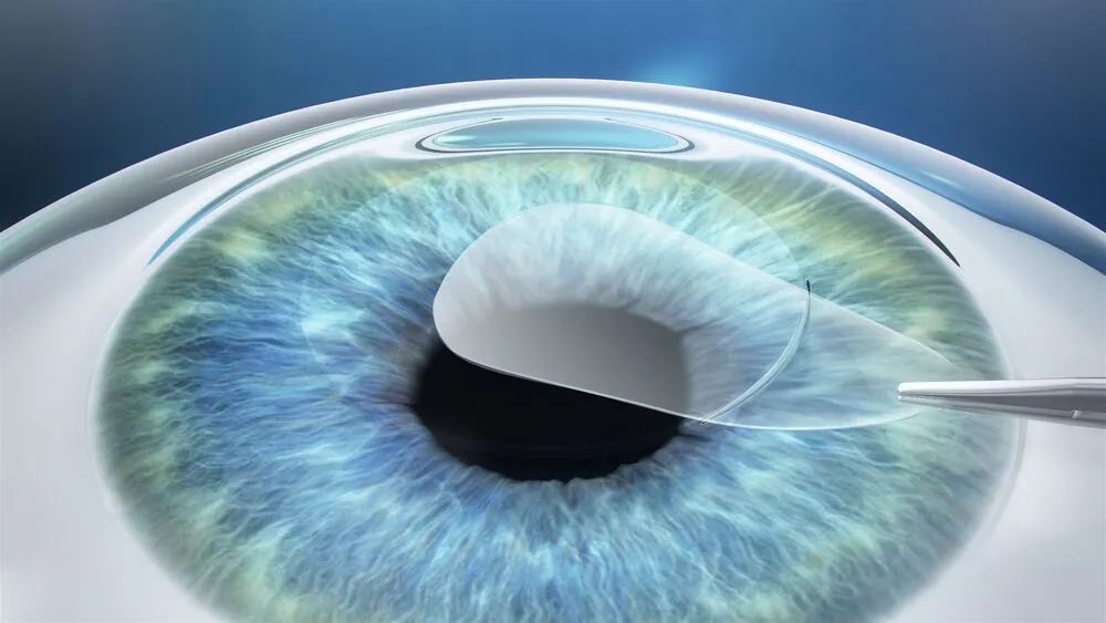 Surgeon removes the lenticule through a micro-incision