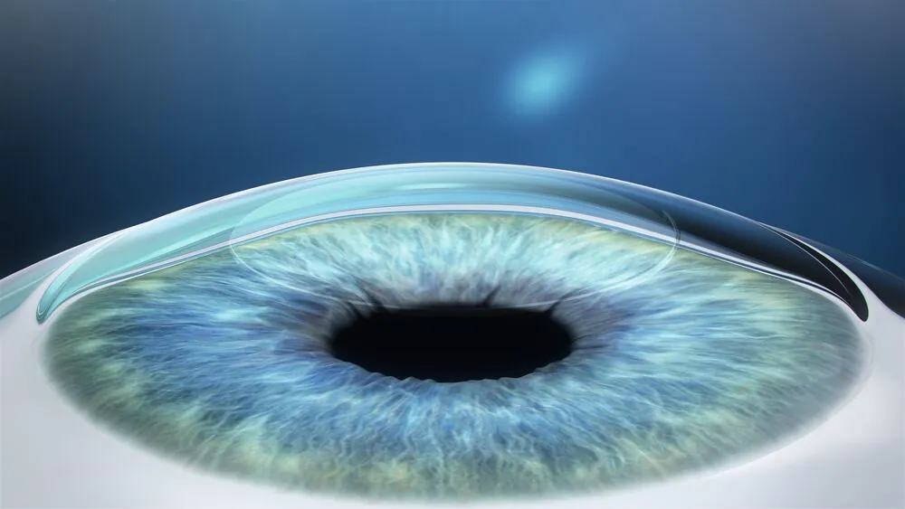 Cornea after SMILE — surface virtually intact