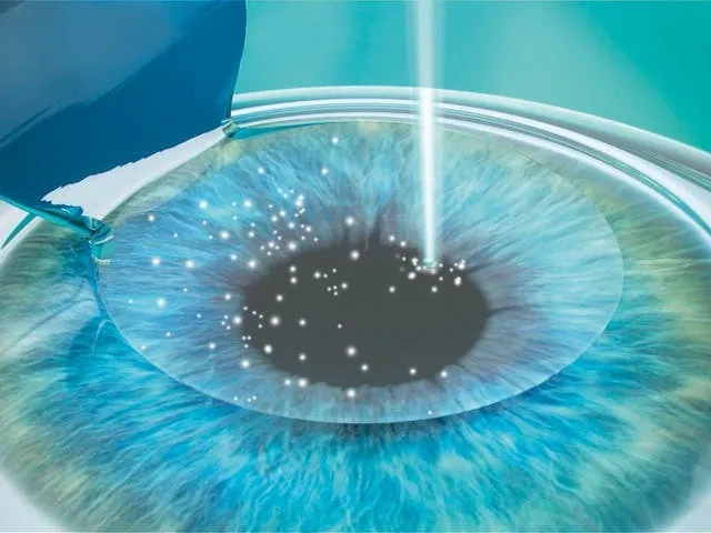 Femto-LASIK illustration