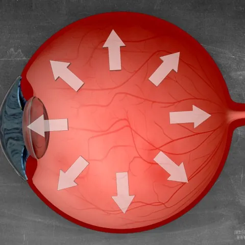 Glaucoma
