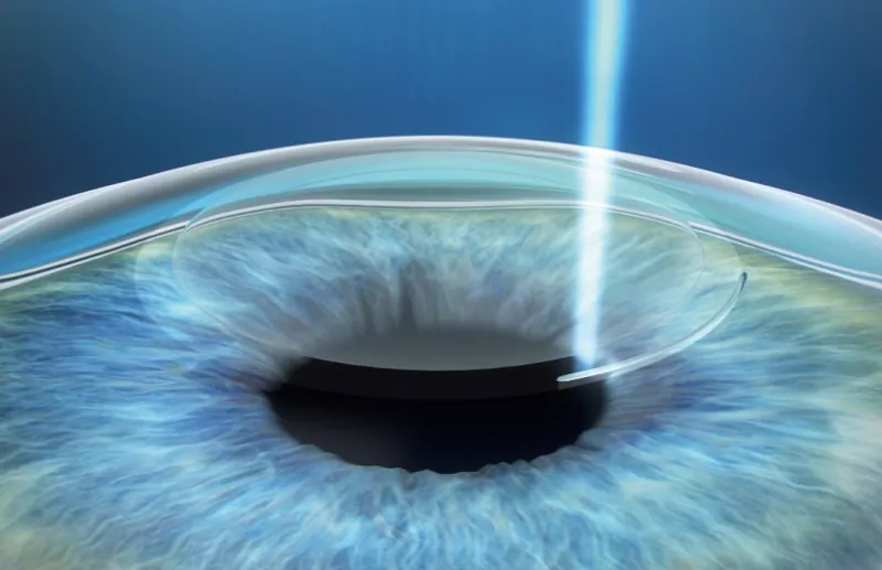 Laser (refractive surgery)