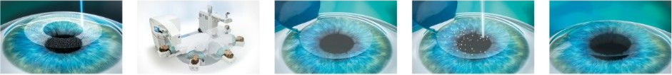 Femto-LASIK ooglaser techniek
